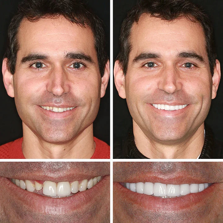 🔥Ends Today: 70% OFF!(Affordable Beauty🧏‍♀️🧏‍♂️)--KLENIMORE™ --Advanced Customized Full Denture Set🦷