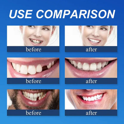 🔥Ends Today: 70% OFF!(Affordable Beauty🧏‍♀️🧏‍♂️)--KLENIMORE™ --Advanced Customized Full Denture Set🦷