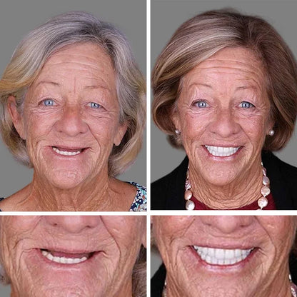 🔥Ends Today: 70% OFF!(Affordable Beauty🧏‍♀️🧏‍♂️)--KLENIMORE™ --Advanced Customized Full Denture Set🦷