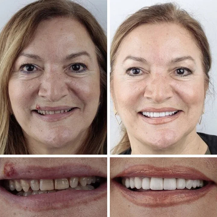 🔥Ends Today: 70% OFF!(Affordable Beauty🧏‍♀️🧏‍♂️)--KLENIMORE™ --Advanced Customized Full Denture Set🦷