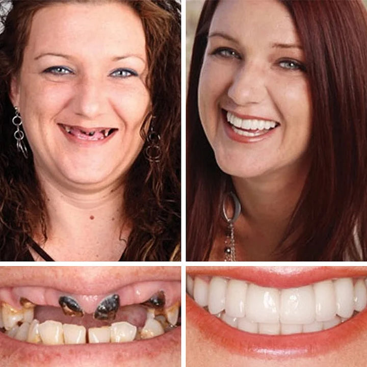 🔥Ends Today: 70% OFF!(Affordable Beauty🧏‍♀️🧏‍♂️)--KLENIMORE™ --Advanced Customized Full Denture Set🦷