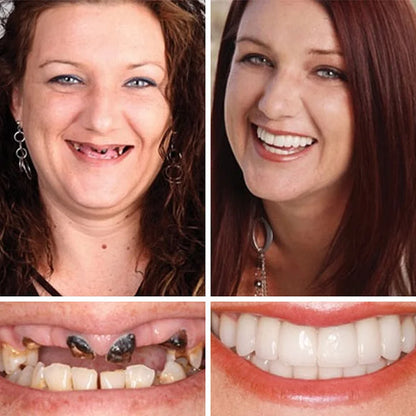 🔥Ends Today: 70% OFF!(Affordable Beauty🧏‍♀️🧏‍♂️)--KLENIMORE™ --Advanced Customized Full Denture Set🦷
